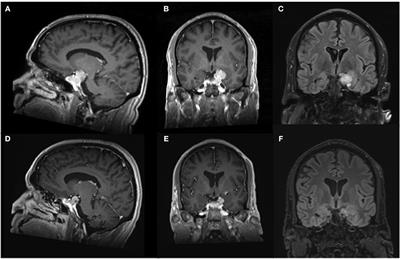 Case Report: Suprasellar Pituitary Adenoma Presenting With Temporal Lobe Seizures